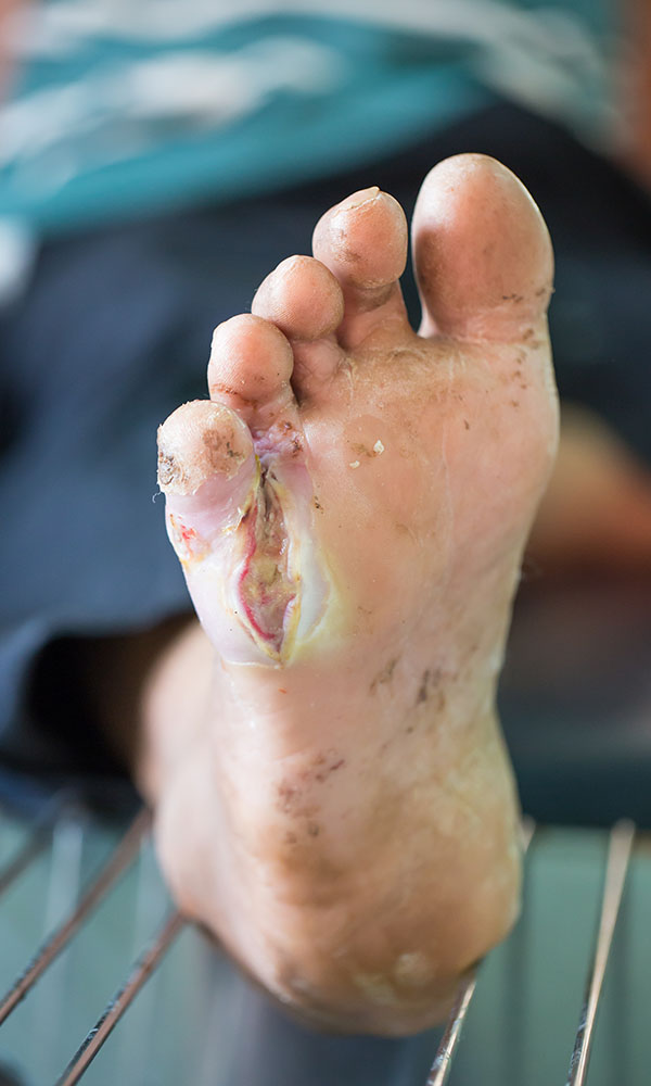 Close-up clinical view of a diabetic foot ulcer on the sole of the foot