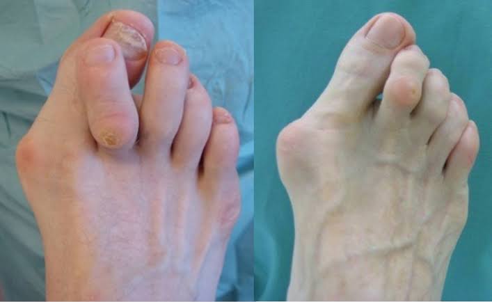 Clinical photograph of a foot with hallux valgus (bunion) deformity