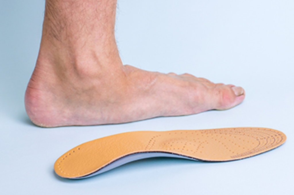 Foot with a lowered arch beside a supportive orthotic insole