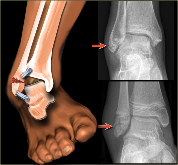 Illustration of an ankle fracture with corresponding X-rays showing the broken bone