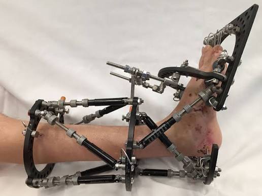 Circular frame external fixator for limb reconstruction