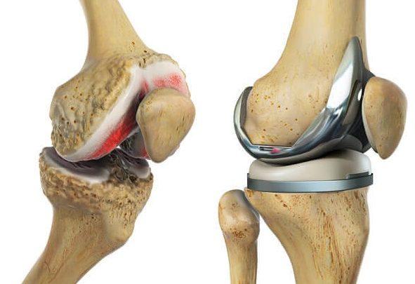 Illustration of an arthritic knee alongside a knee replacement implant